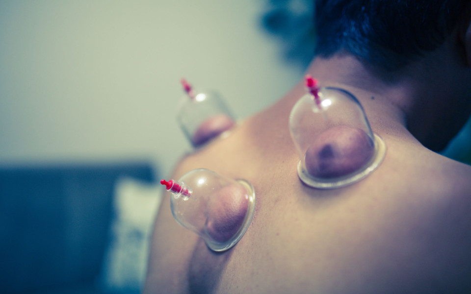 Does Cupping Therapy Work?