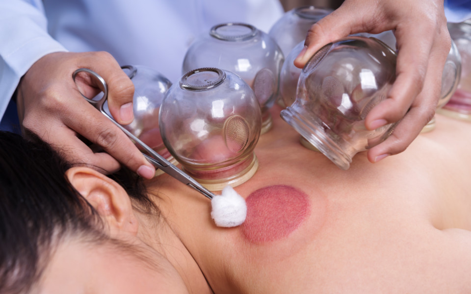 How to Perform Cupping Therapy